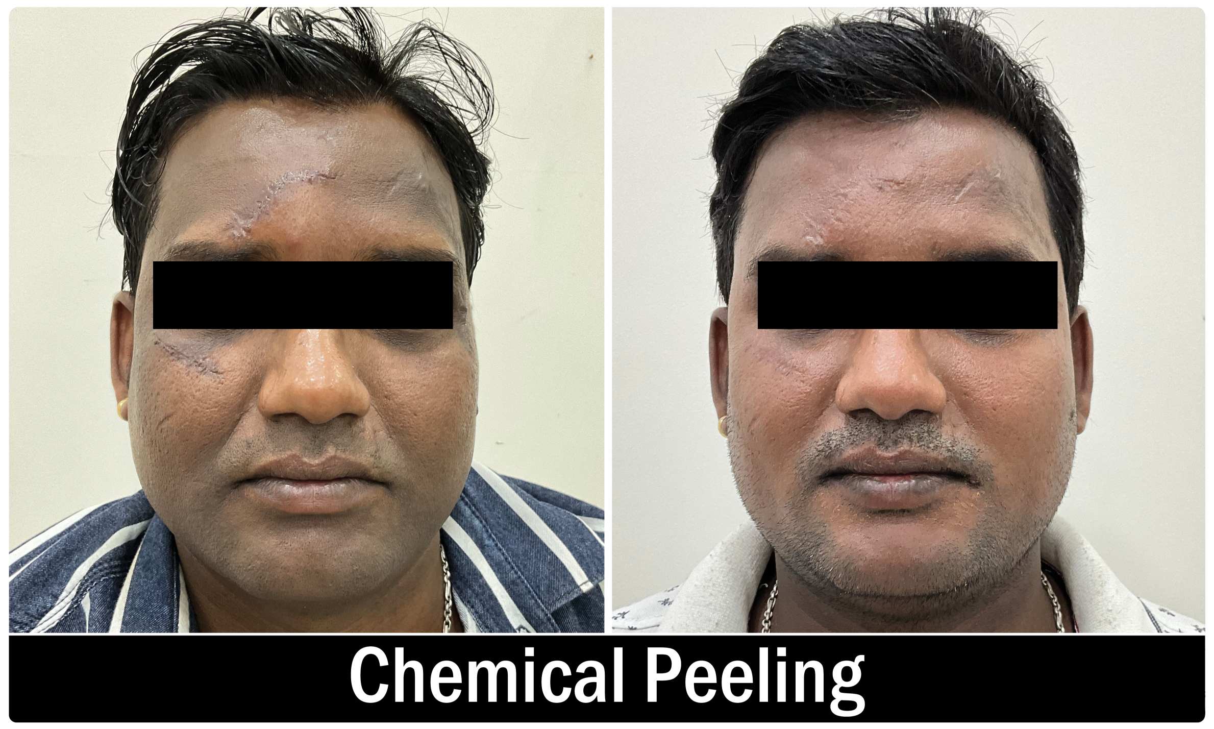 Chemical Peeling Treatment KOQ10